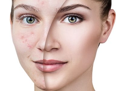 Sivilce Ve İz Tedavisi