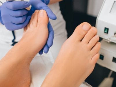 Lazer İle Tırnak Mantarı Tedavisi